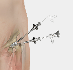 Hip Arthoscopy