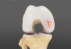 Articular Cartilage Defects