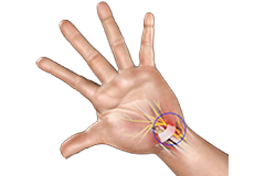 Carpal Tunnel Syndrome