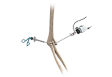 Elbow Arthroscopy