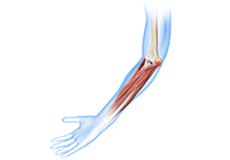 Golfer’s Elbow Surgery
