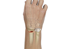 Hand Fracture Care