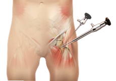 Hip Arthroscopy