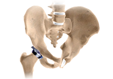 Hip Resurfacing Arthroplasty