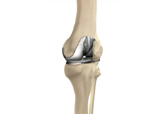 Total Knee Arthroplasty