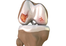 Knee Osteoarthritis