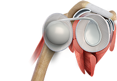 Shoulder Labrum Reconstruction