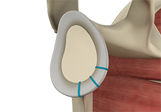 Shoulder Stabilization