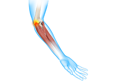 Tennis Elbow Surgery